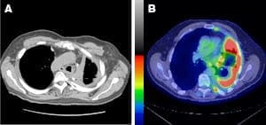 Mesothelioma CT scans CT scans showing malignant mesothelioma