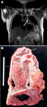 Pleural meso MRI and lung tissue sample Pleural mesothelioma as seen by radiology and pathology